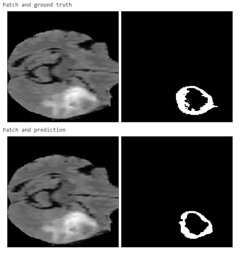 Top: MRI patch with the ground-truth tumor mask. Bottom: the same patch with the model’s prediction.