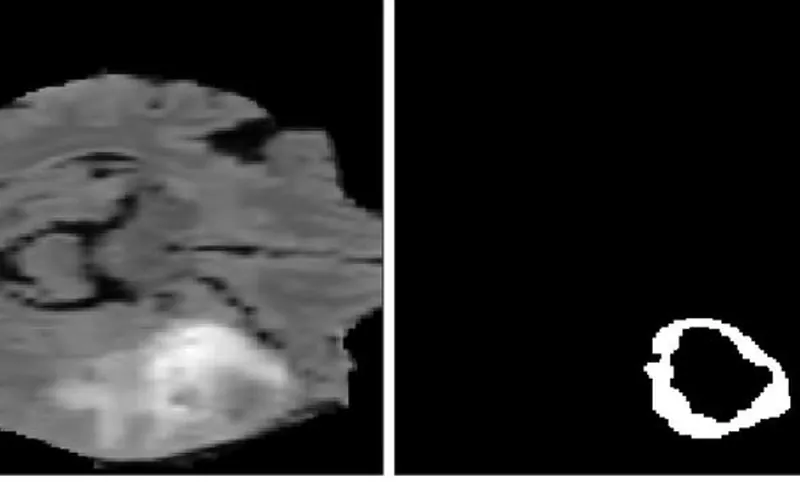 Brain tumor segmentation in MRI — project visual