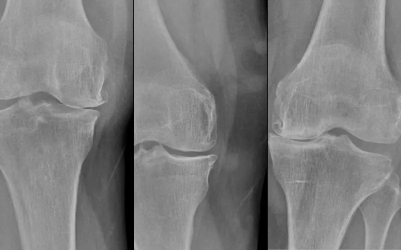 Generative AI for knee X-rays — project visual